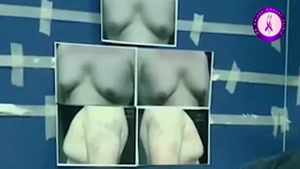 ژنیکوماستی - جراحی سینه در مردان