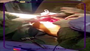 فیلم تعویض مفصل ران در بیمار پنجاه ساله