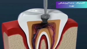 فیلم عصب کشی دندان واقعی