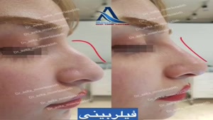 نمونه کارهای تزریق فیلر بینی