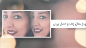 چهار سال بعد از جراحی بینی