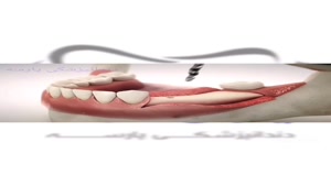 فیلم مراحل ایمپلنت دندان