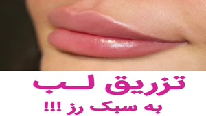 فیلم تزریق ژل | کلینیک رز | 02144067005 | شماره 145