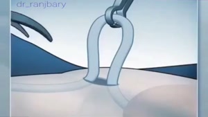 انیمیشن جراحی وازکتومی با نمای ساده 