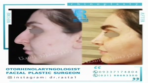 نمونه جراحی بینی دکتر نسرین راستا