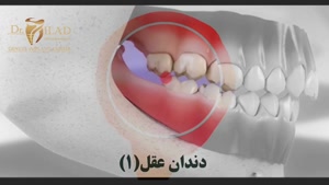 جراحی دندان عقل (بخش اول)