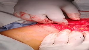 فیلم جراحی درمان درگیری عصب دست به دنبال جراحی زیبایی بازو