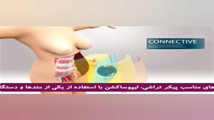 افراد کاندید برای انجام ابدومینوپلاستی