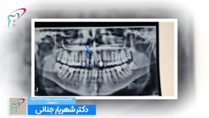 جراحی دندان ۲ همراه با پیوند پودر استخوان