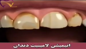 انیمیشن لمینت دندان