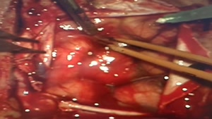 فیلم جراحی کیست کلوئید مغزی با هیدروسفالی شدید