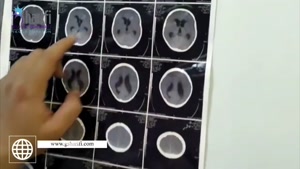 3 عمل جراحی تومور مغزی در 3 کودک توسط دکتر گیو شریفی