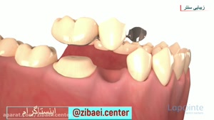 بریج دندان یا پل دندان - دندان مصنوعی - زیبایی سنتر