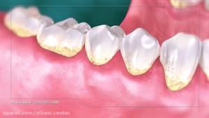 جرم گیری دندان یا بروساژ دندان - زیبایی سنتر