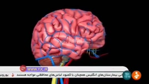 سکته مغزی ۲۵ بیمار مبتلا به ویروس کرونا