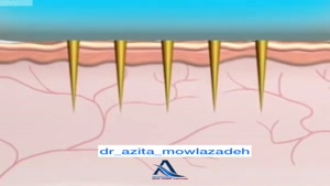 جوانسازی پوست با لیزر آر اف فراکشنال