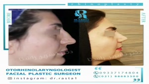 جراحی زیبایی بینی در زنان