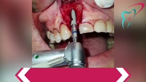 کشیدن و ایمپلنت همزمان دندان