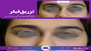 تزریق فیلر زیر چشم در کلینیک ارکیده 