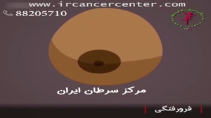 12 نشانه برای تشخيص سرطان سينه 