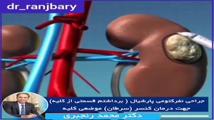 انیمیشن جراحی نفرکتومی پارشیال