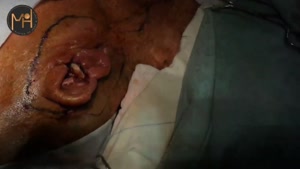 فیلم جراحی تومور گردنی