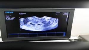 سونوگرافی بارداری دوقلویی با داروهای تحریک تخمک گذاری