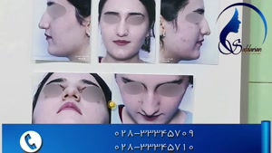 فیلم جدید جراحی زیبایی بینی توسط دکتر صفدریان