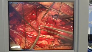 فیلم جراحی تومور نخاع گردن