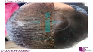 رفع ریزش مو با دستگاه کربوکسی تراپی