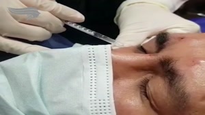 تزریق بوتاکس در پیشانی و دور چشم