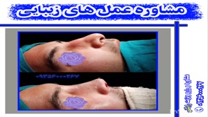 جراحی زیبایی بینی در شیراز