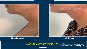 عمل جراحی غبغب شیراز