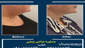 عمل جراحی زیبایی غبغب شیراز
