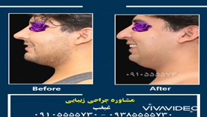 عمل جراحی زیبایی غبغب در شیراز 