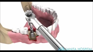 کلیپ مراحل کاشت دندان / ایمپلنت