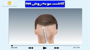  کاشت مو به روش fue 