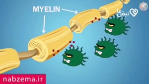 بیماری ام اس رو بشناسیم