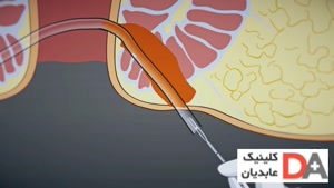 درمان فیستول مقعدی بدون جراحی - درمان تهران