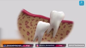 مراحل جراحی دندان عقل نهفته