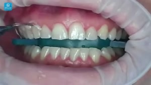 مراحل انجام بلیچینگ دندان 