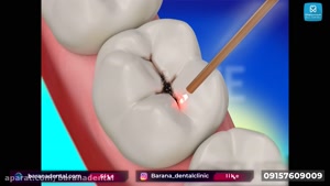 از بین بردن پوسیدگی دندان با لیزر