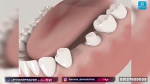 مراحل انجام بریج دندان 