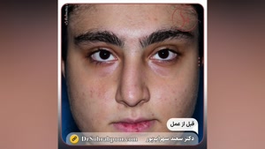  فیلم عمل زیبایی بینی - بهترین جراح بینی در تهران