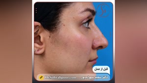 قبل و بعد عمل زیبایی بینی توسط دکتر سعید سهراب پور