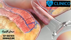 درمان بواسیر با لیزر - فیلم لیزر هموروئید - درمان کلینیک