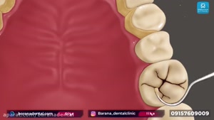 جرم گیری دندان به چه صورتی انجام می شود؟ 