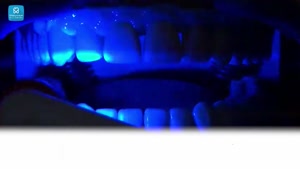 بلیچینگ دندان بهتر است یا ارتودنسی؟ 
