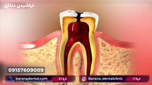 مراحل عصب کشی دندان به چه صورت است؟