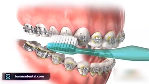 ارتودنسی و تاثیر آن در سلامت دهان و دندان کودکان 
